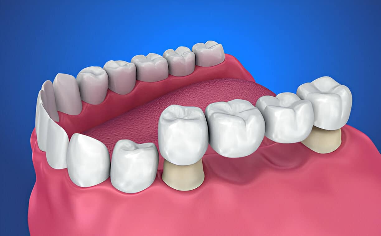 Transform Your Smile with Dental Crowns: Expert Tips and Insights_1