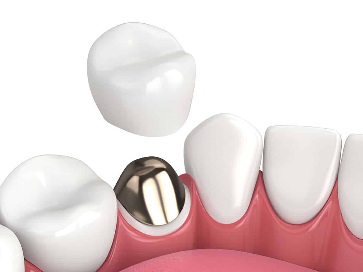 How to Maintain and Care for Different Types of Dental Crowns_1