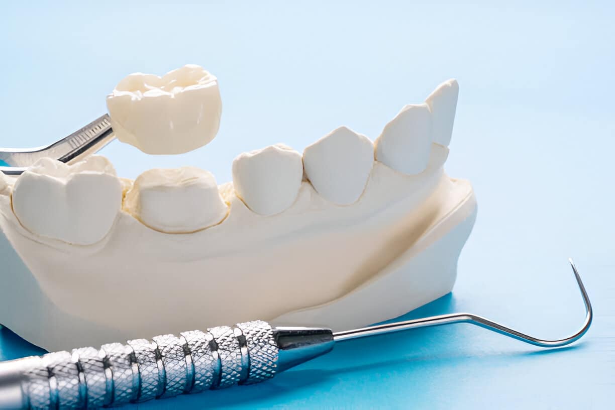 How to Maintain and Care for Different Types of Dental Crowns_3