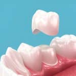 How to Maintain and Care for Different Types of Dental Crowns_FI