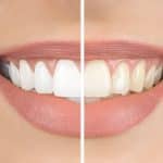 Your Guide to Teeth Whitening at Loves Park Family Dental in Loves Park_FI