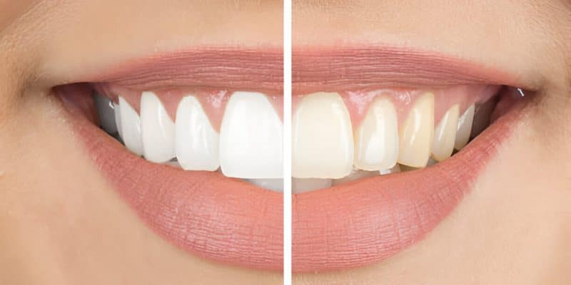 Your Guide to Teeth Whitening at Loves Park Family Dental in Loves Park_FI