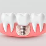 Restore Your Smile with Dental Implants at Loves Park Family Dental, the Trusted Dentist in Loves Park, Illinois_FI