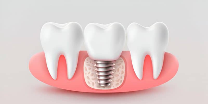 Restore Your Smile with Dental Implants at Loves Park Family Dental, the Trusted Dentist in Loves Park, Illinois_FI